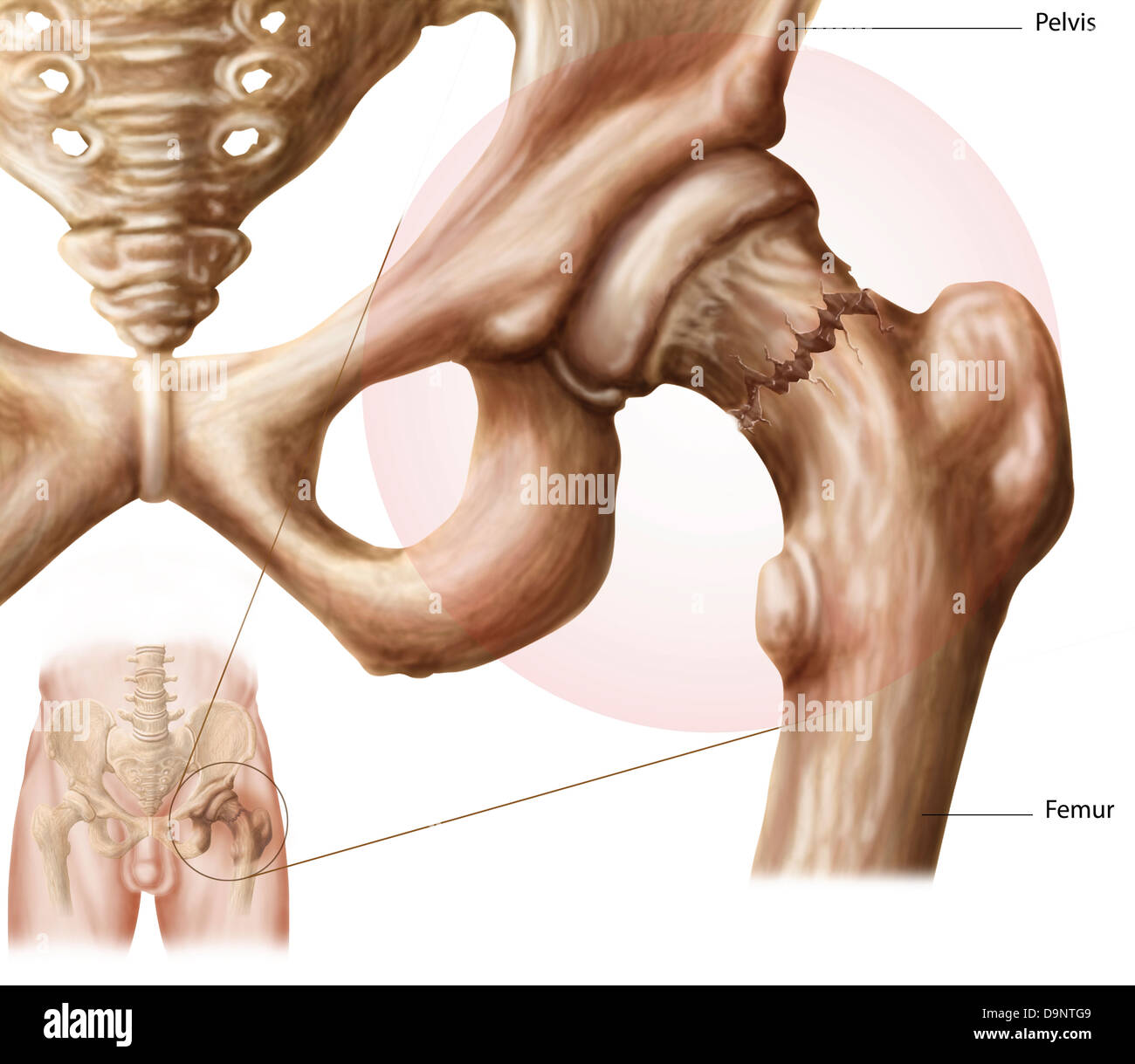 Anatomie d'une fracture de la hanche. Banque D'Images