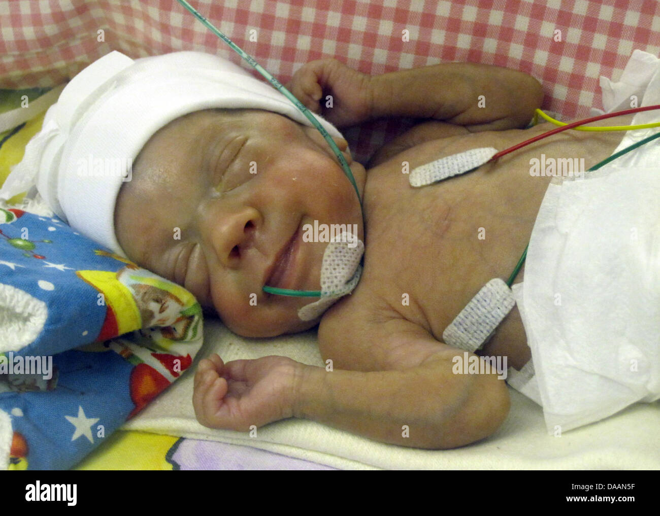 Un Enfant Premature Se Trouve Dans Un Lit A Dortmund En Allemagne Le 28 Novembre 10 Elle A Survecu A Un Poids De Seulement 280 Grammes Apres Pres De Cinq Mois A Un Enfant Premature Se Trouve Dans Un Lit A Dortmund En Allemagne Le 28 Novembre 10 Elle A Survecu A Un Poids De Seulement 280 Grammes Apres Pres De Cinq Mois A