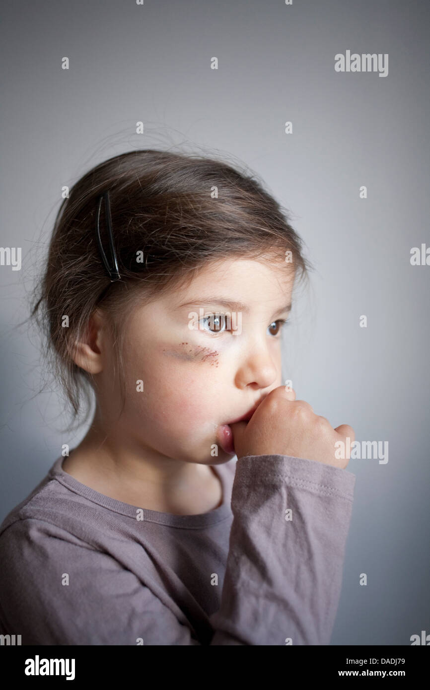 Girl with black eye sucking thumb Banque D'Images