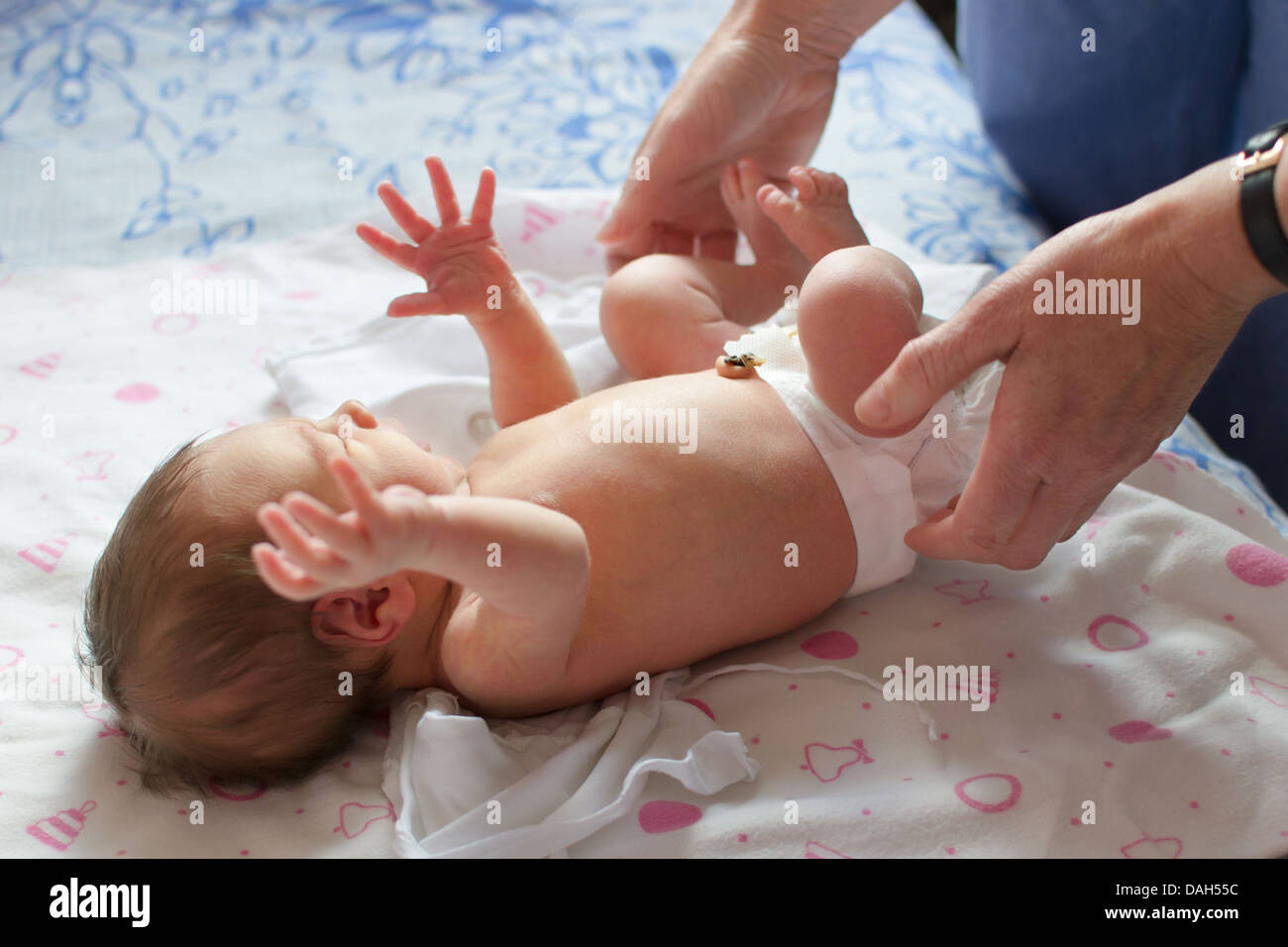 Hernie Ombilicale Banque D Image Et Photos Alamy Hernie Ombilicale Banque D Image Et Photos Alamy