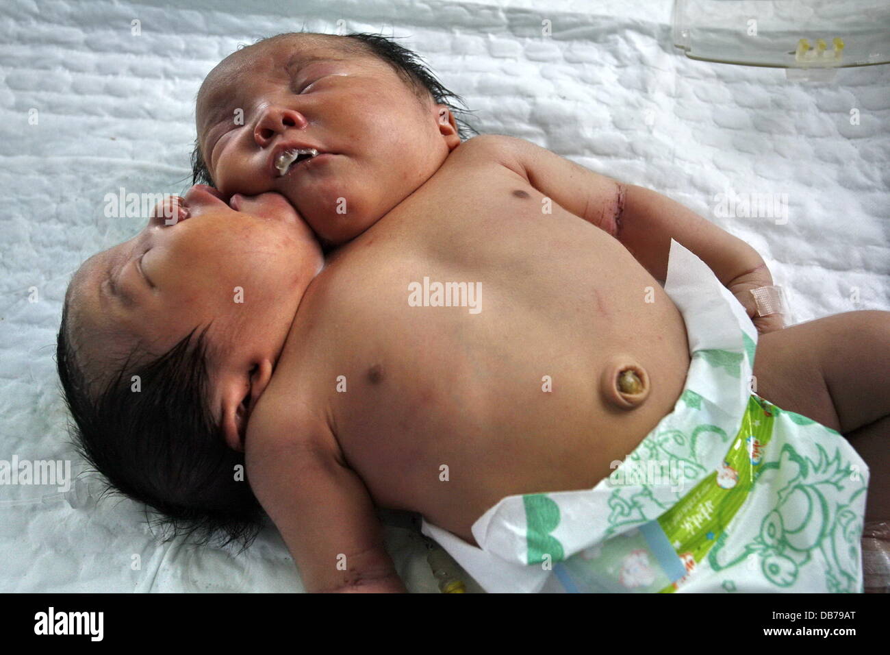 Bébé à deux têtes jumelles Conjoined sont nés dans la ville de Suining, le 5 mai 2011. Deux précédentes acquisitions ultrasonores en septembre et février deux revealled qu'un seul embryon, mais une numérisation finale deux jours avant l'accouchement revealled que la fille de mère Banque D'Images