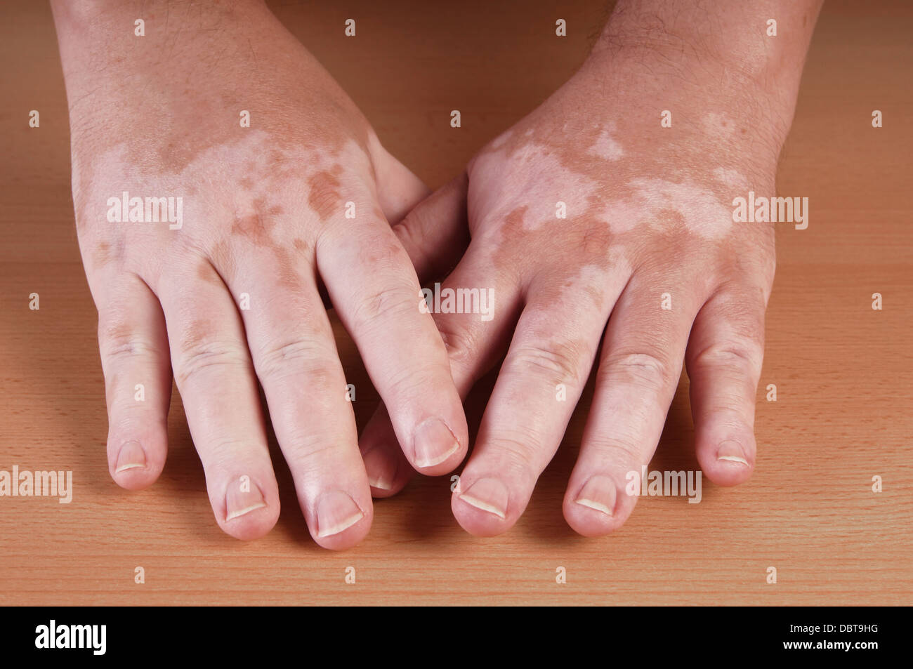 Le vitiligo est une affection causant des plaques de peau Dépigmentation de Banque D'Images