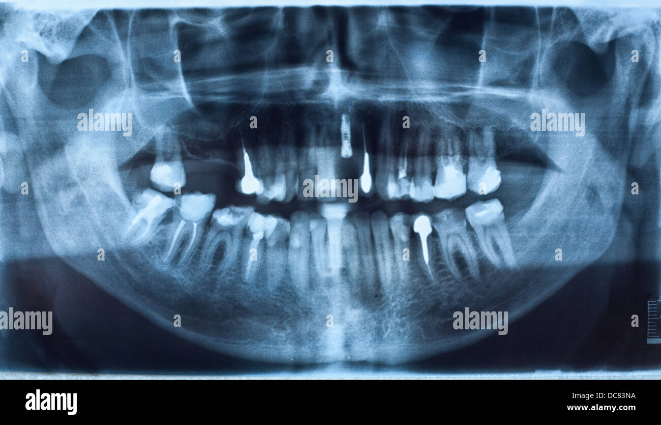 La radiographie dentaire panoramique avec implant Banque D'Images