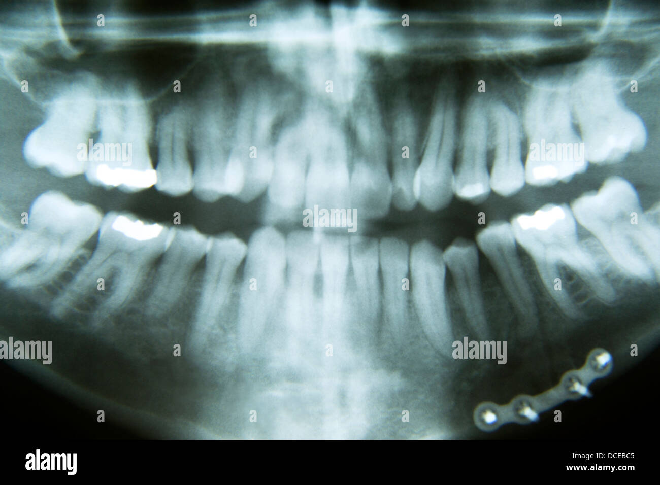 Une radiographie panoramique de réparation de fracture de la mâchoire ...