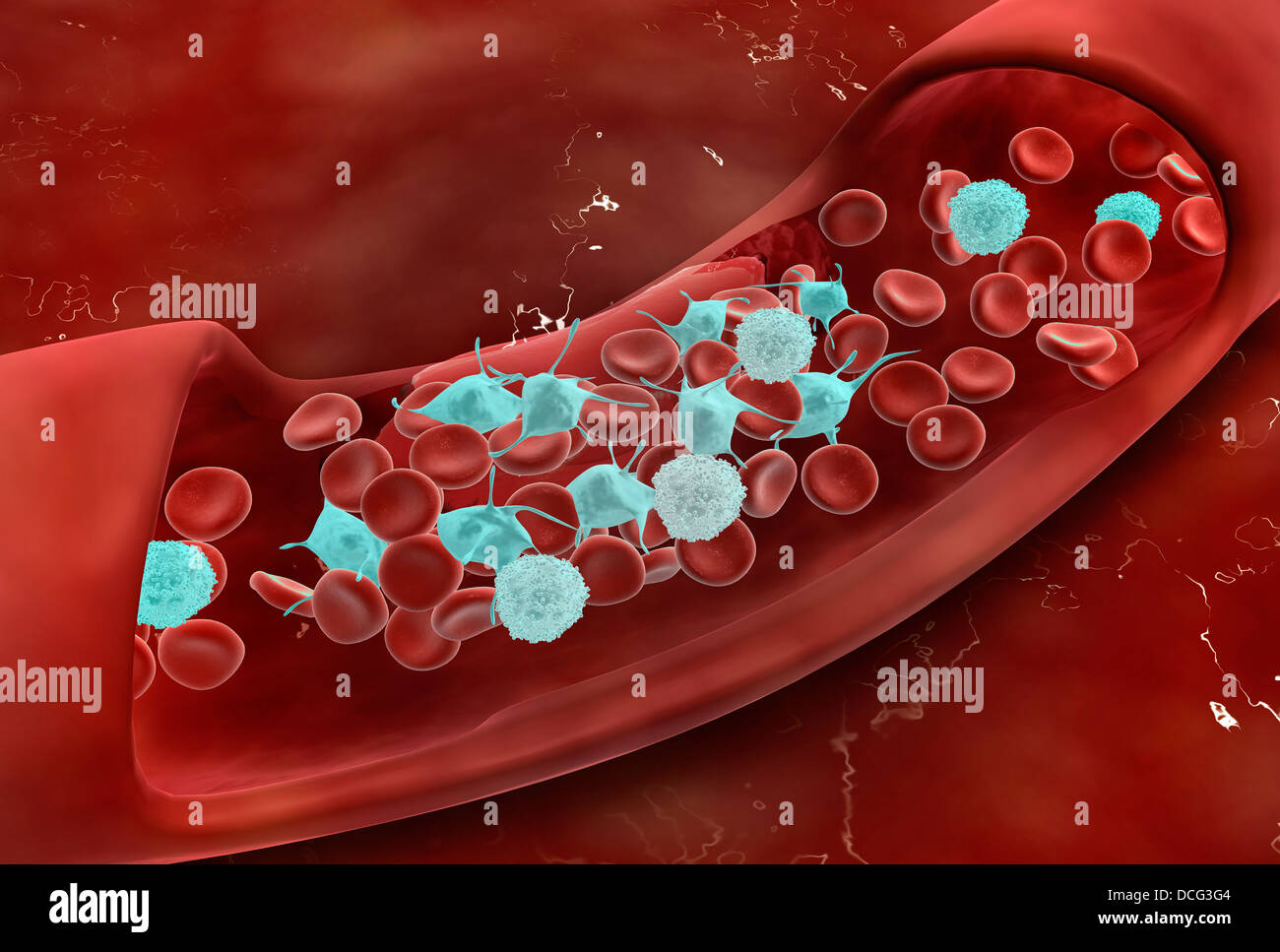 Vue microscopique de la coagulation du sang à l'intérieur de l'artère. Banque D'Images