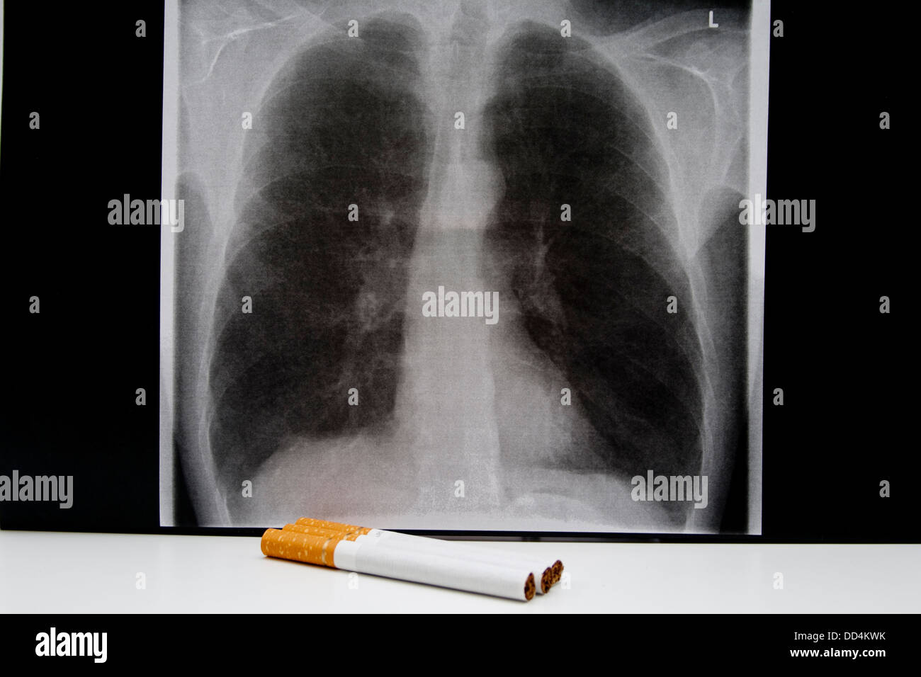 Photo pulmonaire avec des cigarettes Banque D'Images