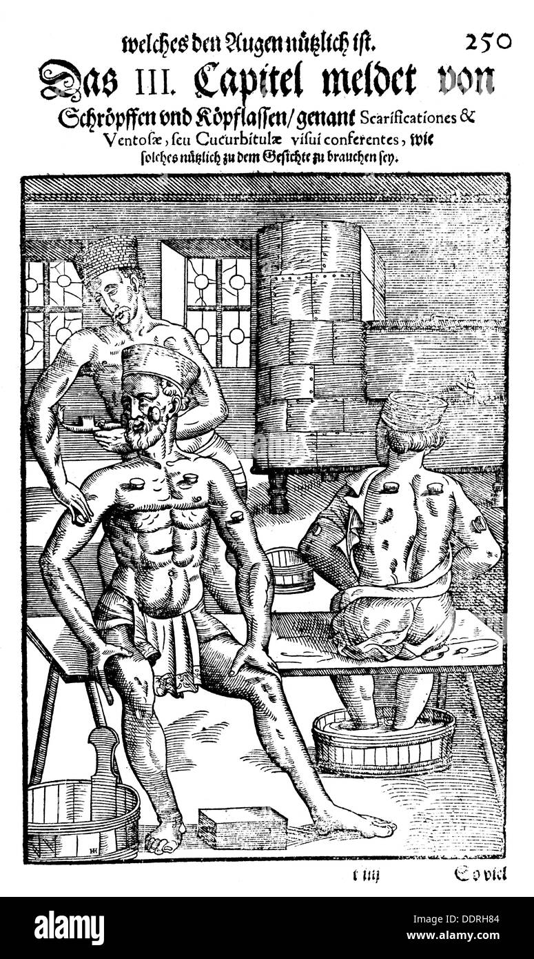 Médecine, traitement, examen / thérapie / consultation, traitement de la cupping contre les plaintes oculaires, coupe de bois, de: Georg Bartisch (1535 - 1607), 'Ophtalmoduleia, das ist Augendienst, Dresde, 1583, droits additionnels-Clearences-non disponible Banque D'Images