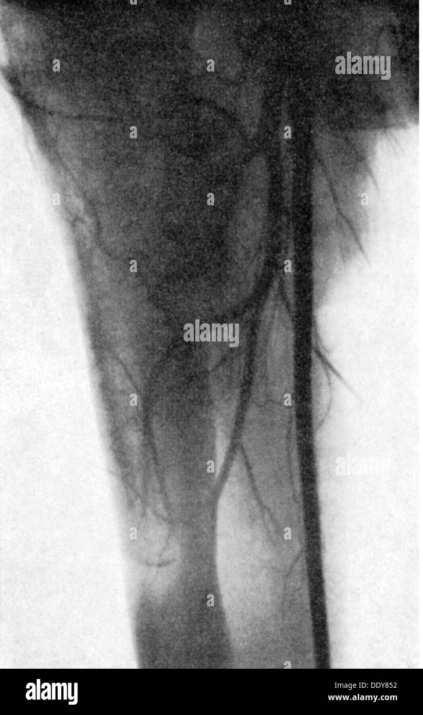 Médecine, anatomie, squelette / os, cuisse humaine mâle, angiographie, 20e siècle, 20e siècle, radiographie, image radiologique, radiographie, radiographie, radiographie, rayonsX, rayonnement, jambe, jambes, cuisses, cuisse, vaisseau sanguin, vaisseaux sanguins, os, os, os, os, os, fémur, fémur, tête du fémur, médecine historique, médecine masculine, médecine non-disponible, médecine historique-hommes, médecine complémentaire Banque D'Images