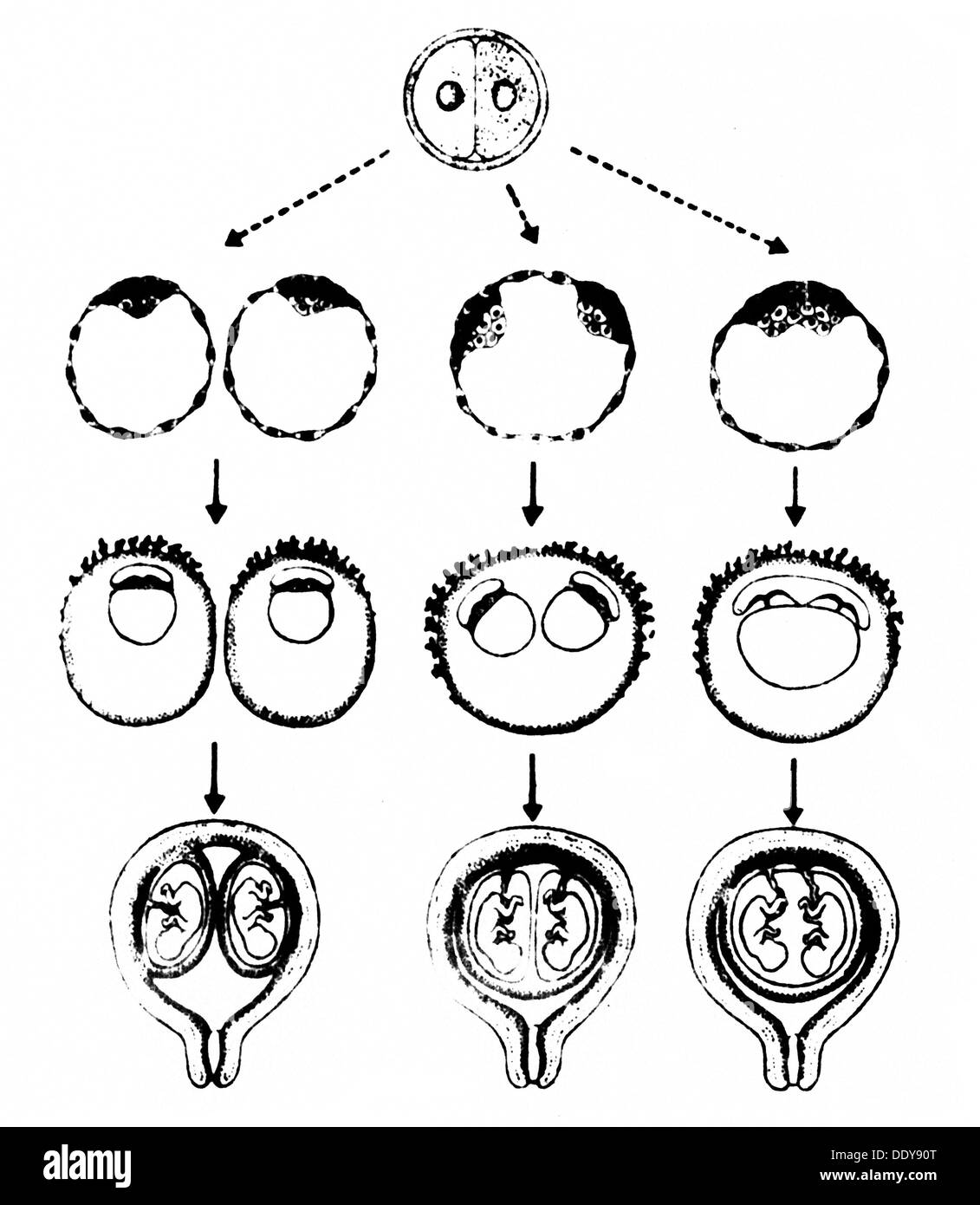 Personnes, jumeaux, schéma du développement possible de jumeaux monozygotes, dessin, de: 'Zeitschrift für Klinische Medizin', 42. Volume, numéro 10, 1987, droits additionnels-Clearences-non disponible Banque D'Images
