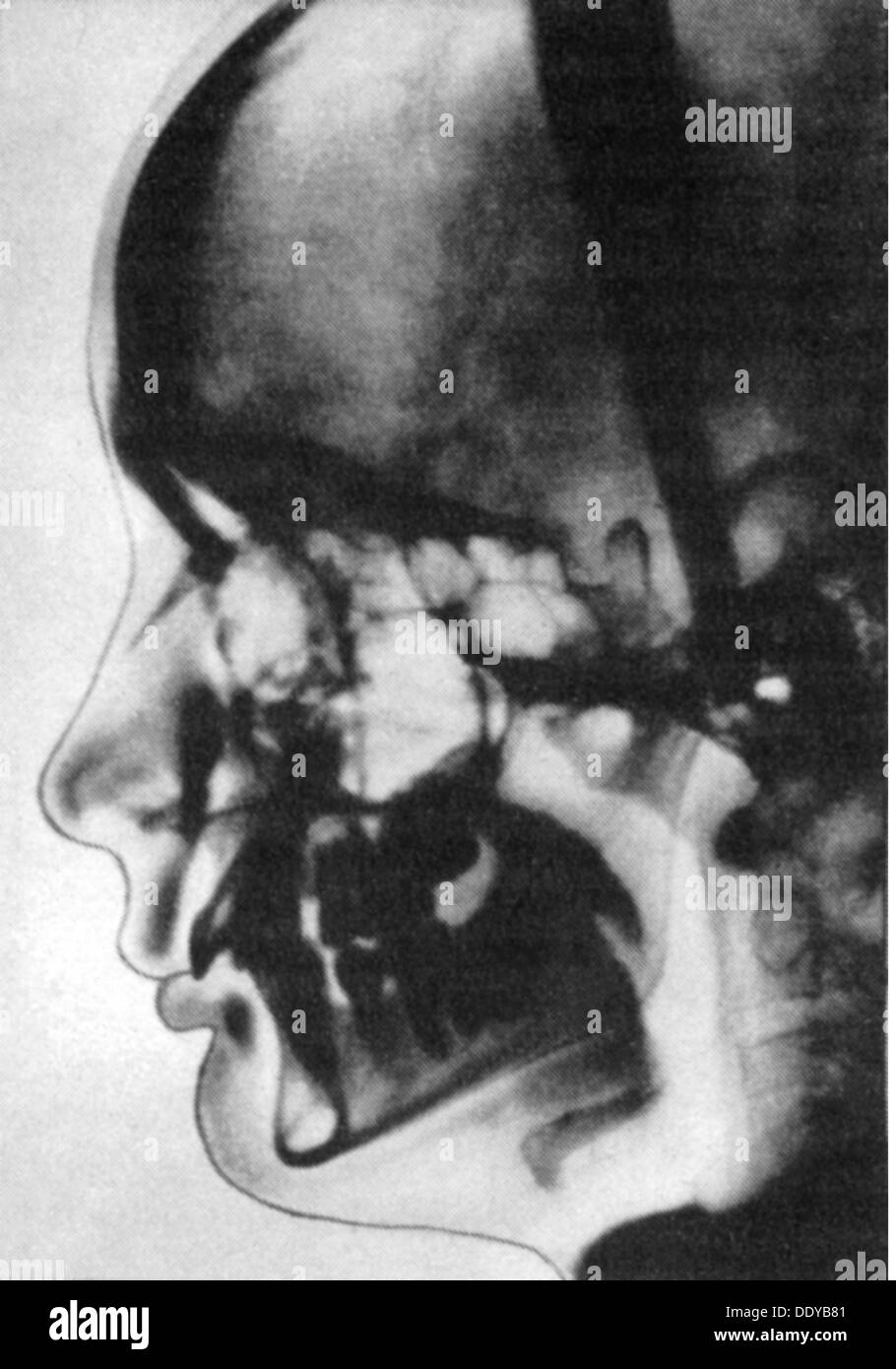 Médecine, irradiation / rayons X / mesure, tomographie d'une tête humaine, 1981, droits additionnels-Clearences-non disponible Banque D'Images