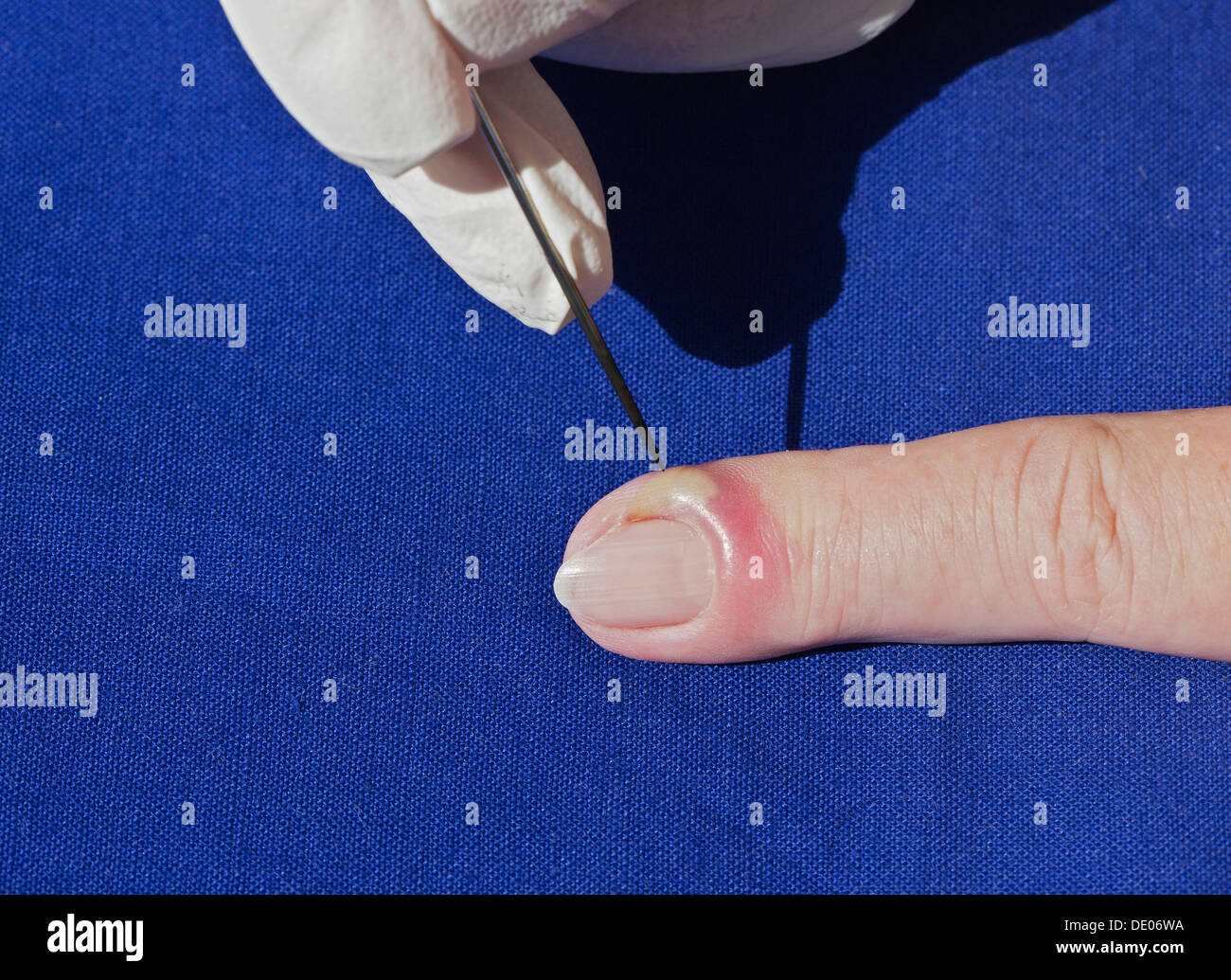 L'infection bactérienne, l'inflammation, index, pus, abcès, aiguille désinfectée, lancing Banque D'Images