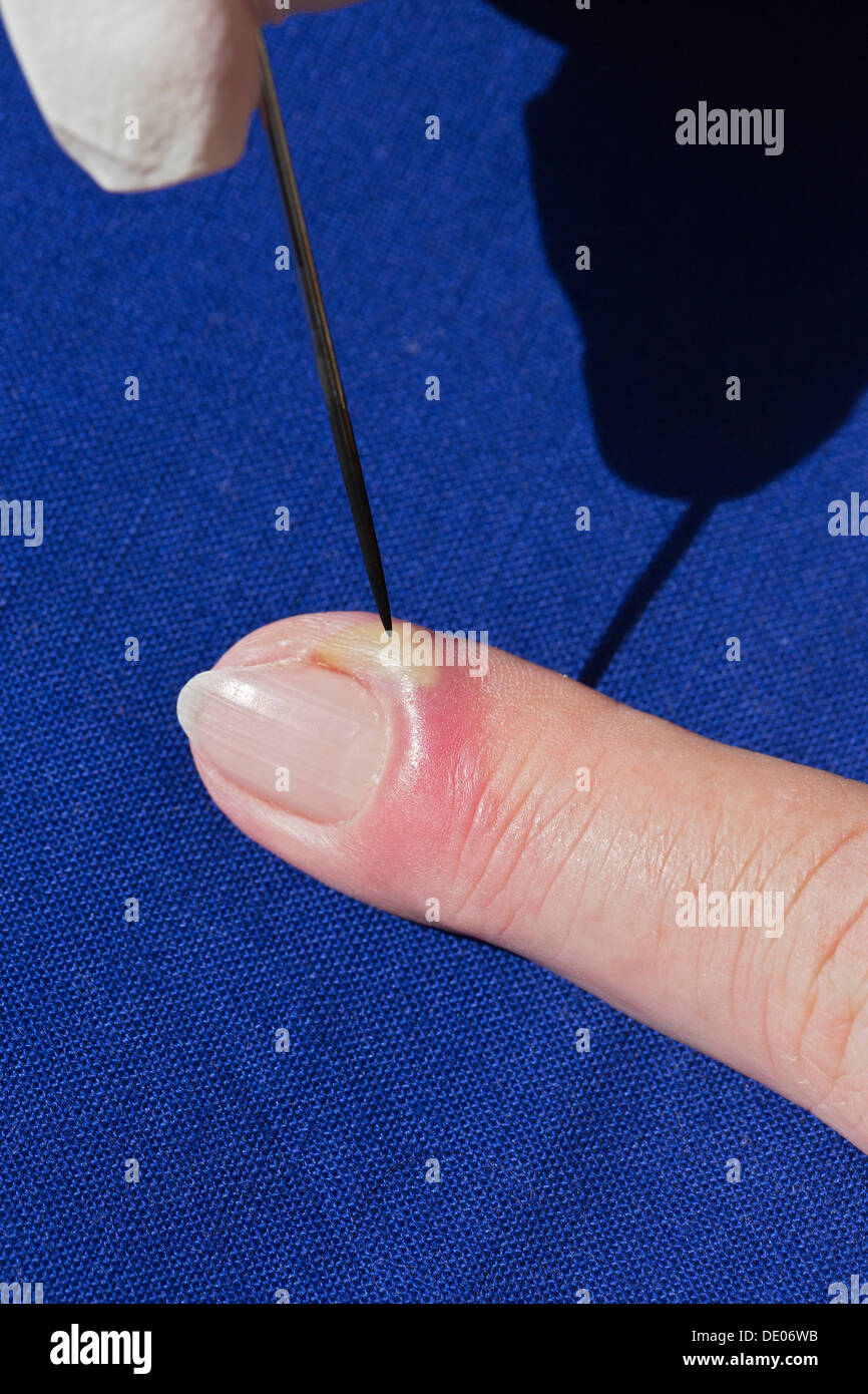 L'infection bactérienne, l'inflammation, index, pus, abcès, aiguille désinfectée, lancing Banque D'Images