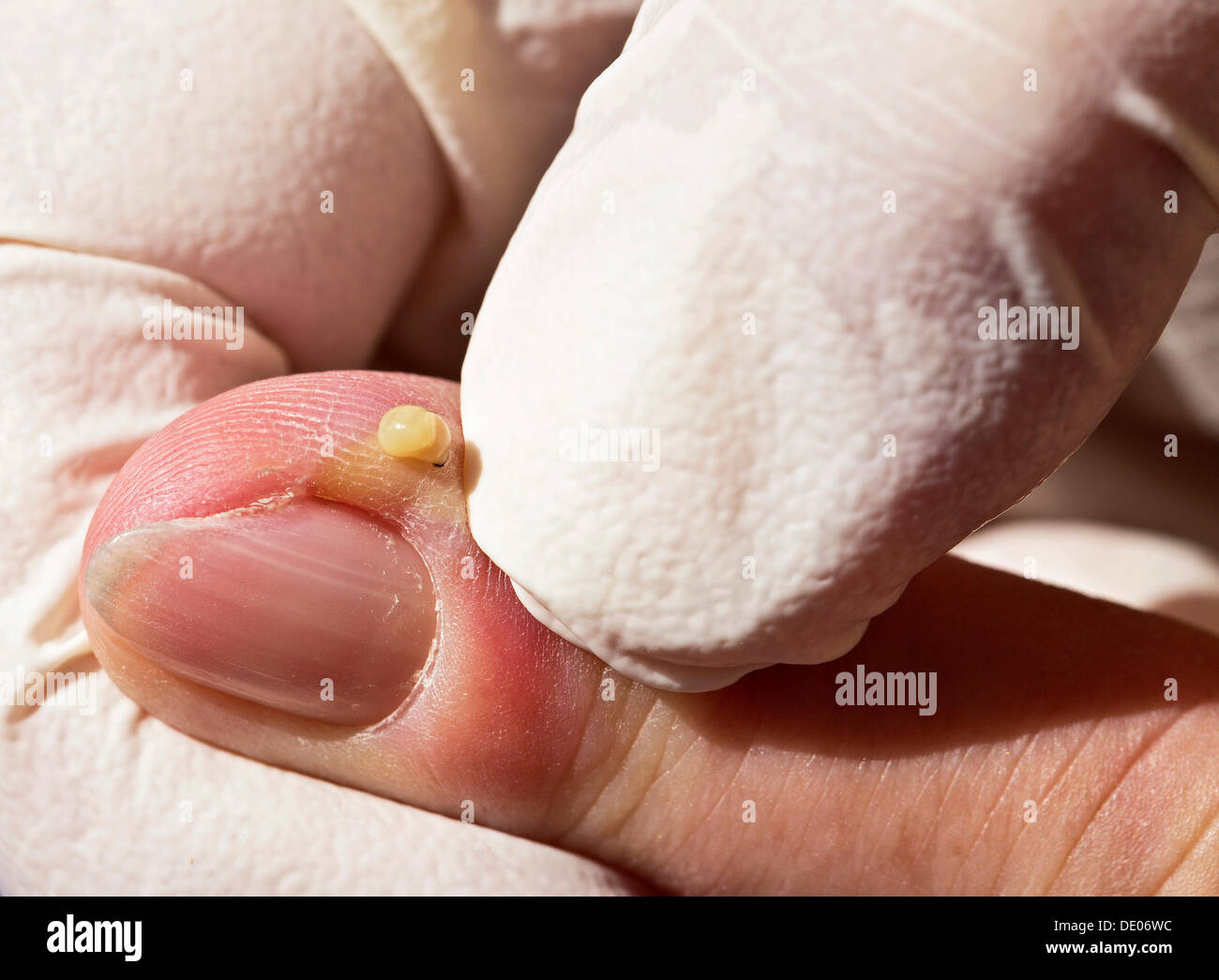 L'infection bactérienne, l'inflammation, index, abcès, retirer du pus, gants chirurgicaux Banque D'Images