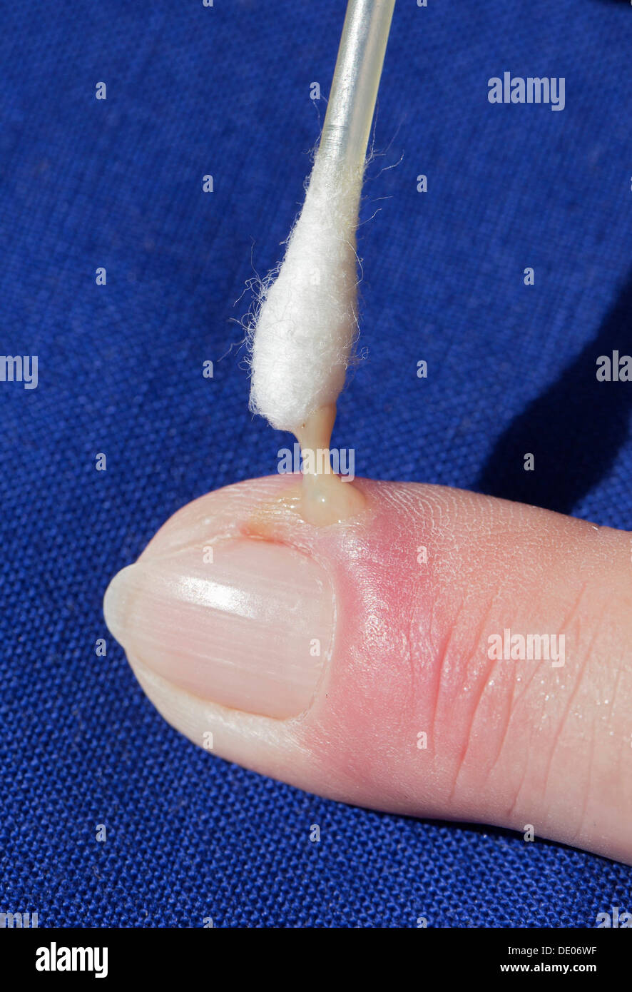 L'infection bactérienne, l'inflammation, index, pus, abcès, swab Banque D'Images