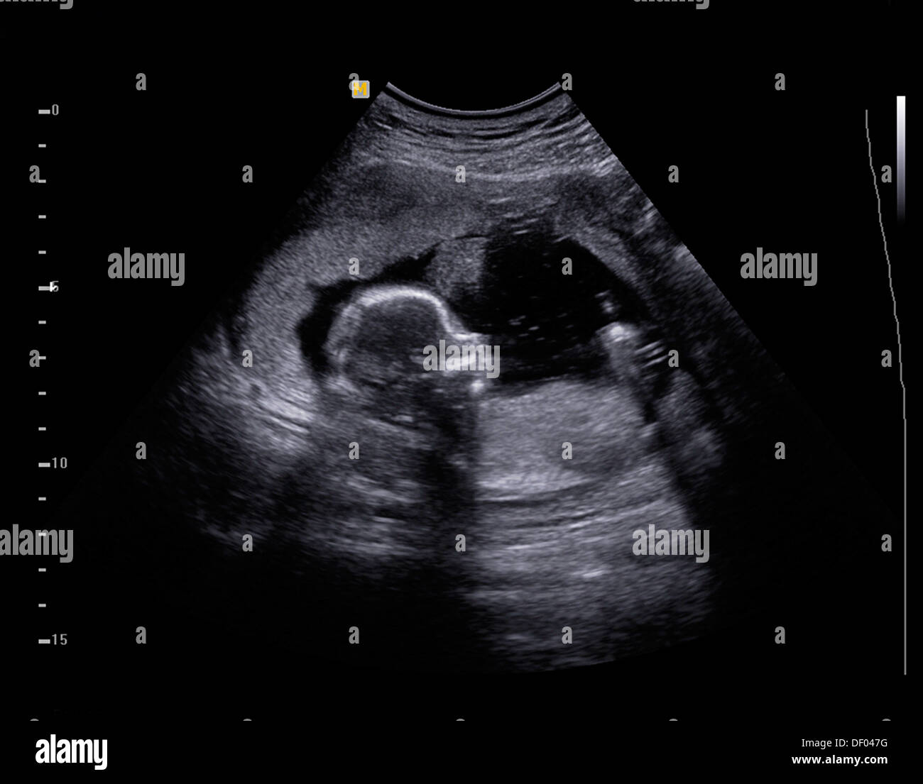 Echographie De Bebe A 5 Mois Photo Stock Alamy