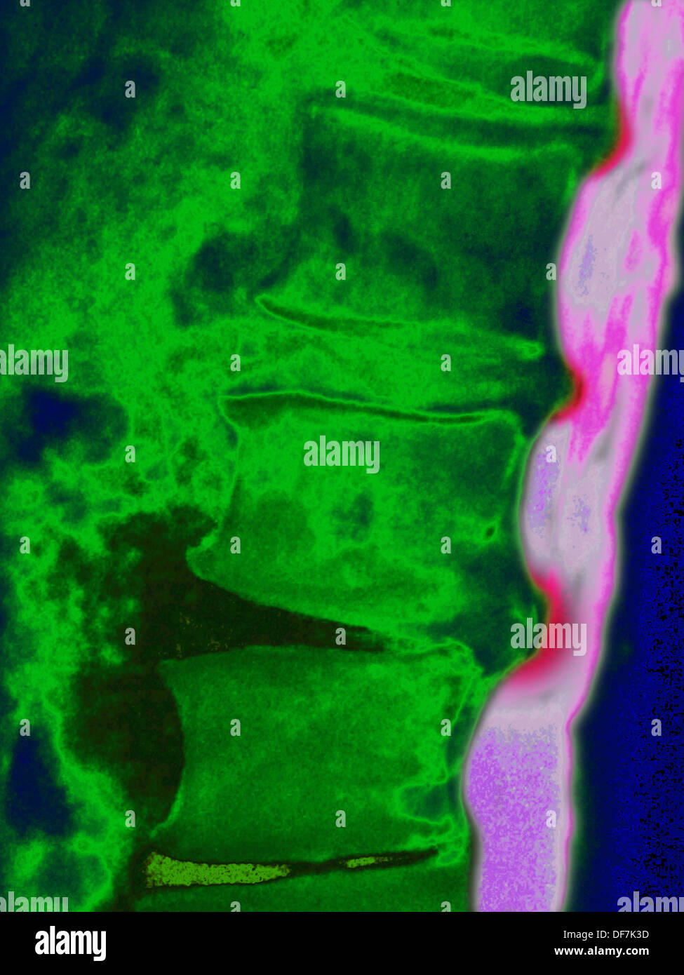 La hernie discale, X-RAY Banque D'Images