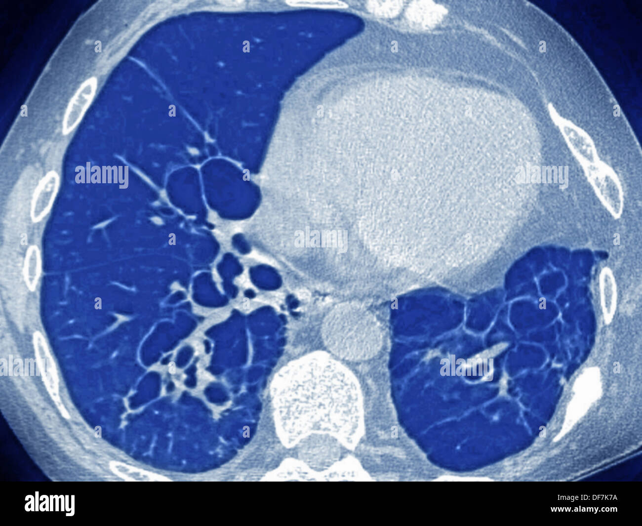 La mucoviscidose, SCAN Banque D'Images