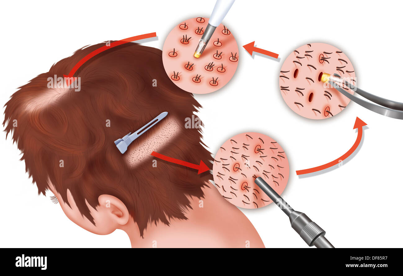 Cheveux IMPLANT, dessin Banque D'Images