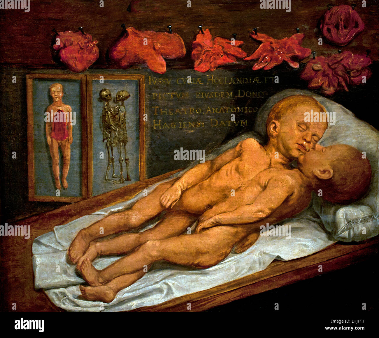 Corps des jumeaux siamois 1630 Gerard van der Maes Peinture musée Néerlandais Pays-Bas Banque D'Images