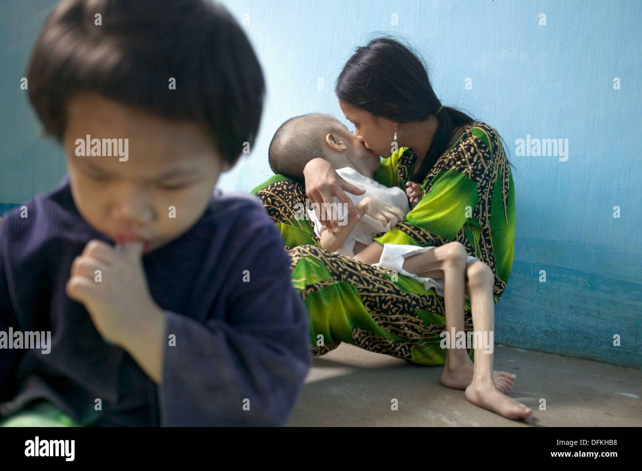 Les enfants de l'exposition à l'severily déformé de la nourriture et de l'eau contaminés par l'agent chimique toxique Orange, Ben Arbre. Vietnam Banque D'Images