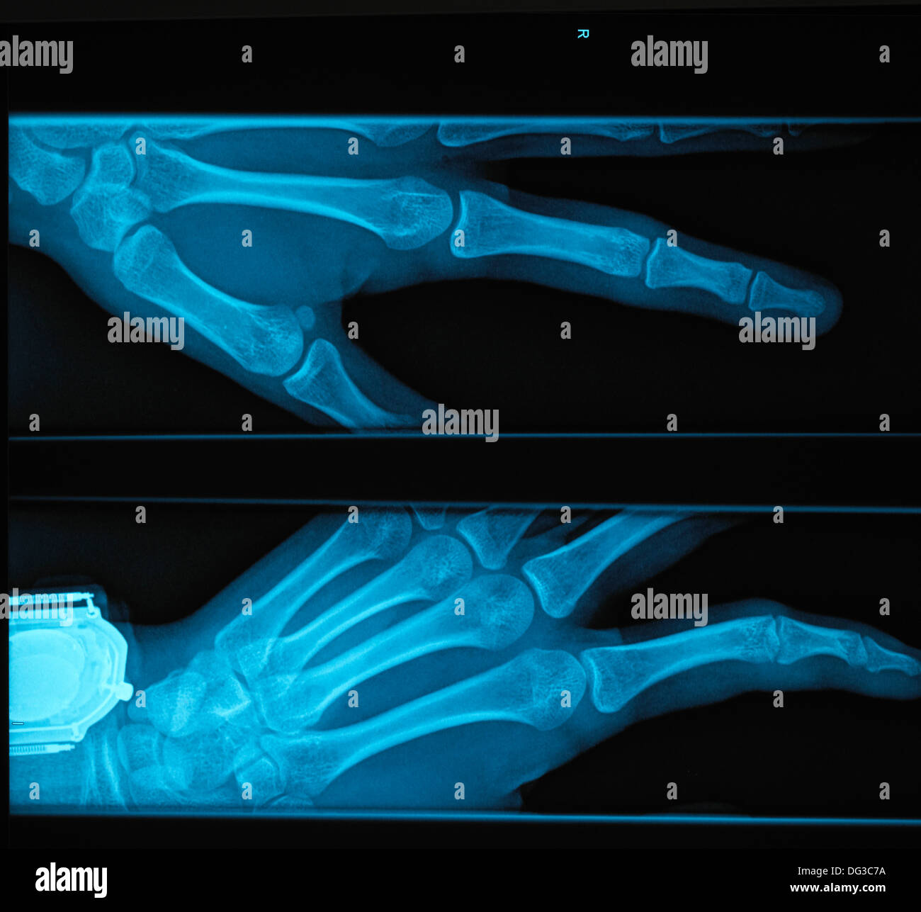 X-Ray de Teen Girl's Hand Banque D'Images
