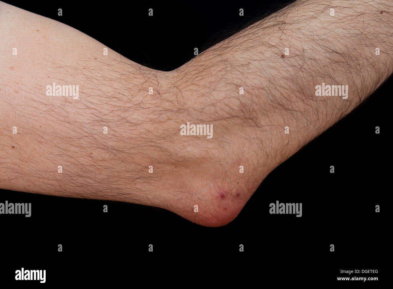 Olecranon bursitis, est une maladie causée par l