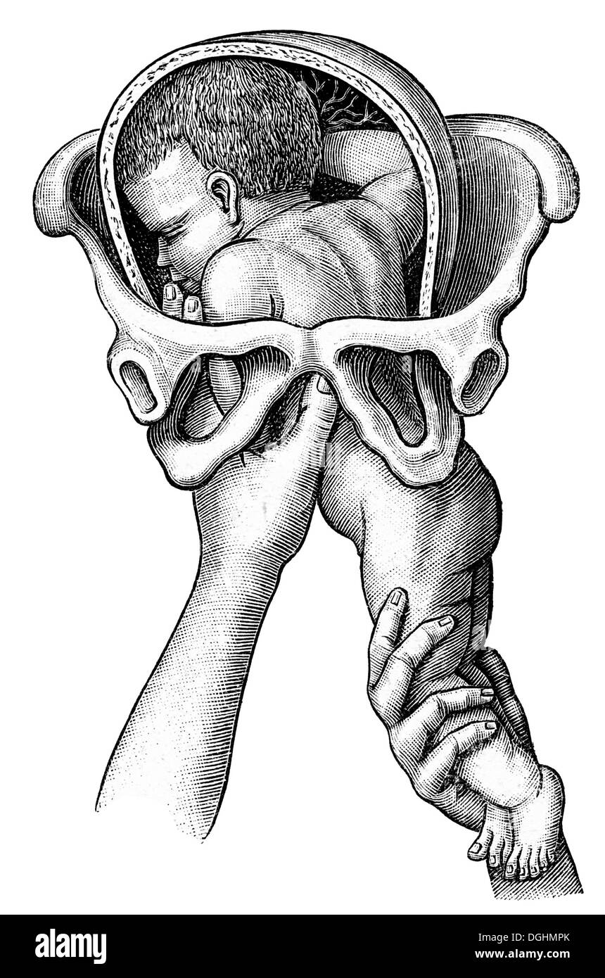 La naissance, illustration historique de : Anna Fischer, Dueckelmann dans la Femme, le médecin de famille, Stuttgart, 1907, p. 705, fig. 395 Banque D'Images