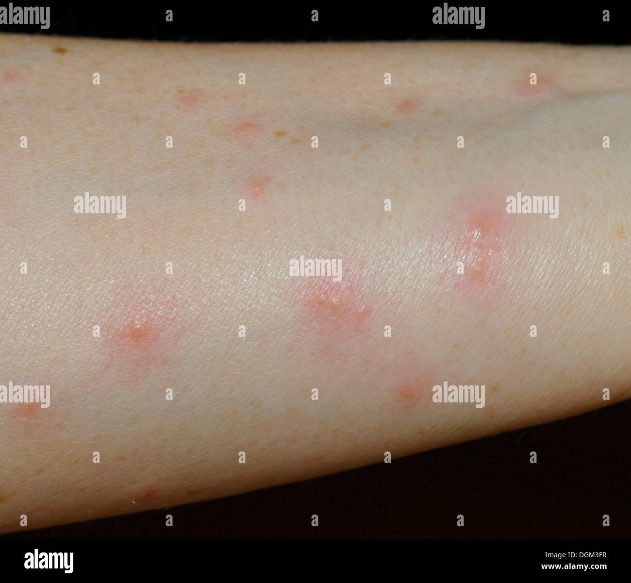 Papules et nodules sur un avant-bras après une réaction allergique à la récolte des acariens (Neotrombicula autumnalis) Banque D'Images
