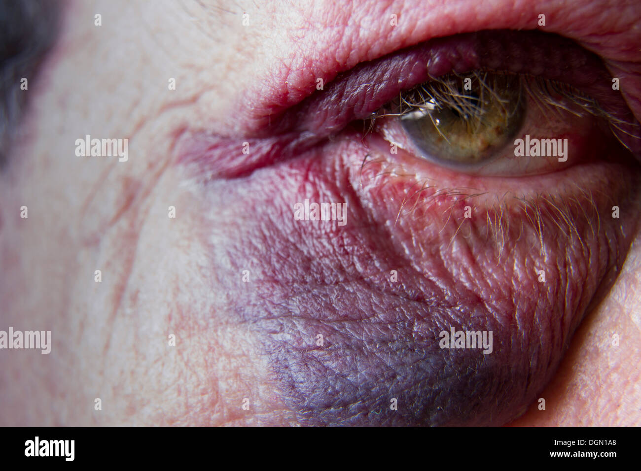 Un homme de soixante ans avec un œil noir et un sang en commun après avoir trébuché sur un trottoir de Los Angeles qui a besoin d'être réparé Banque D'Images