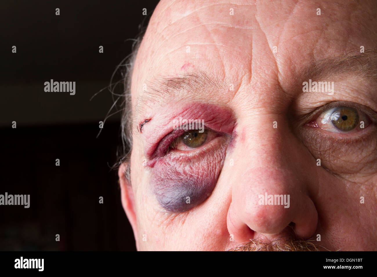 Un homme de soixante ans avec un œil noir et un sang en commun après avoir trébuché sur un trottoir de Los Angeles qui a besoin d'être réparé Banque D'Images