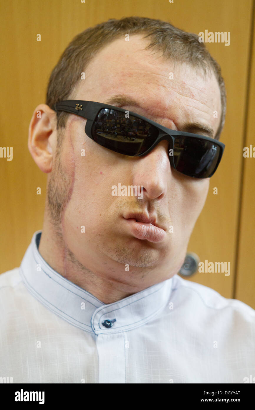 Un homme après greffe du visage au cours de conférence de presse à Gliwice , Pologne. C'est deuxième greffe du visage jamais réalisée. Banque D'Images