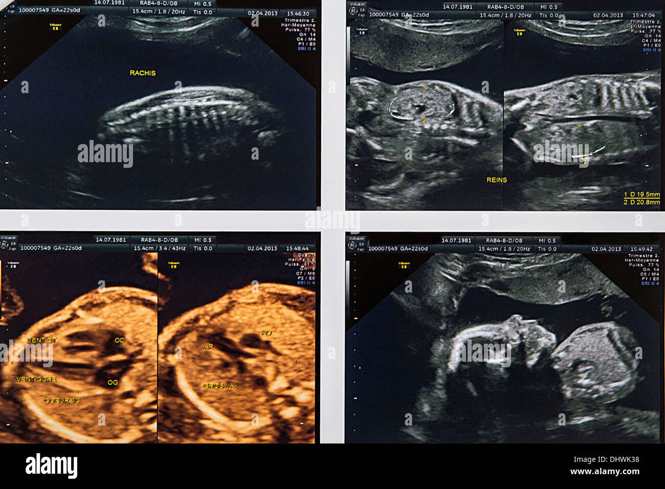 6 Months Foetus Banque D Image Et Photos Alamy