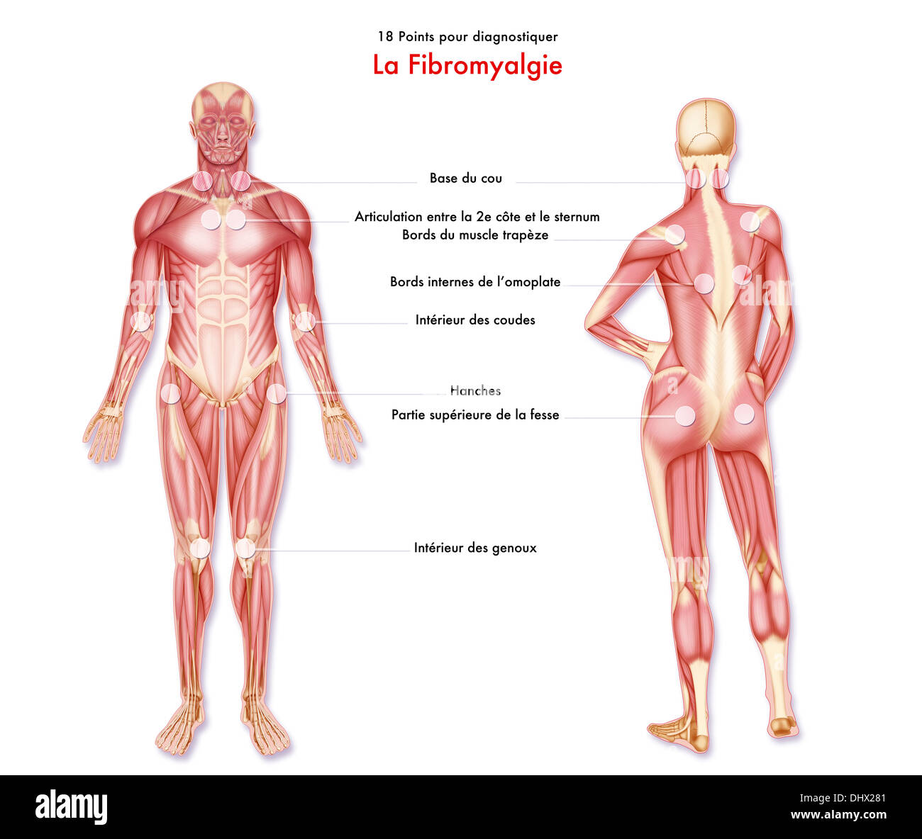 La fibromyalgie, dessin Banque D'Images