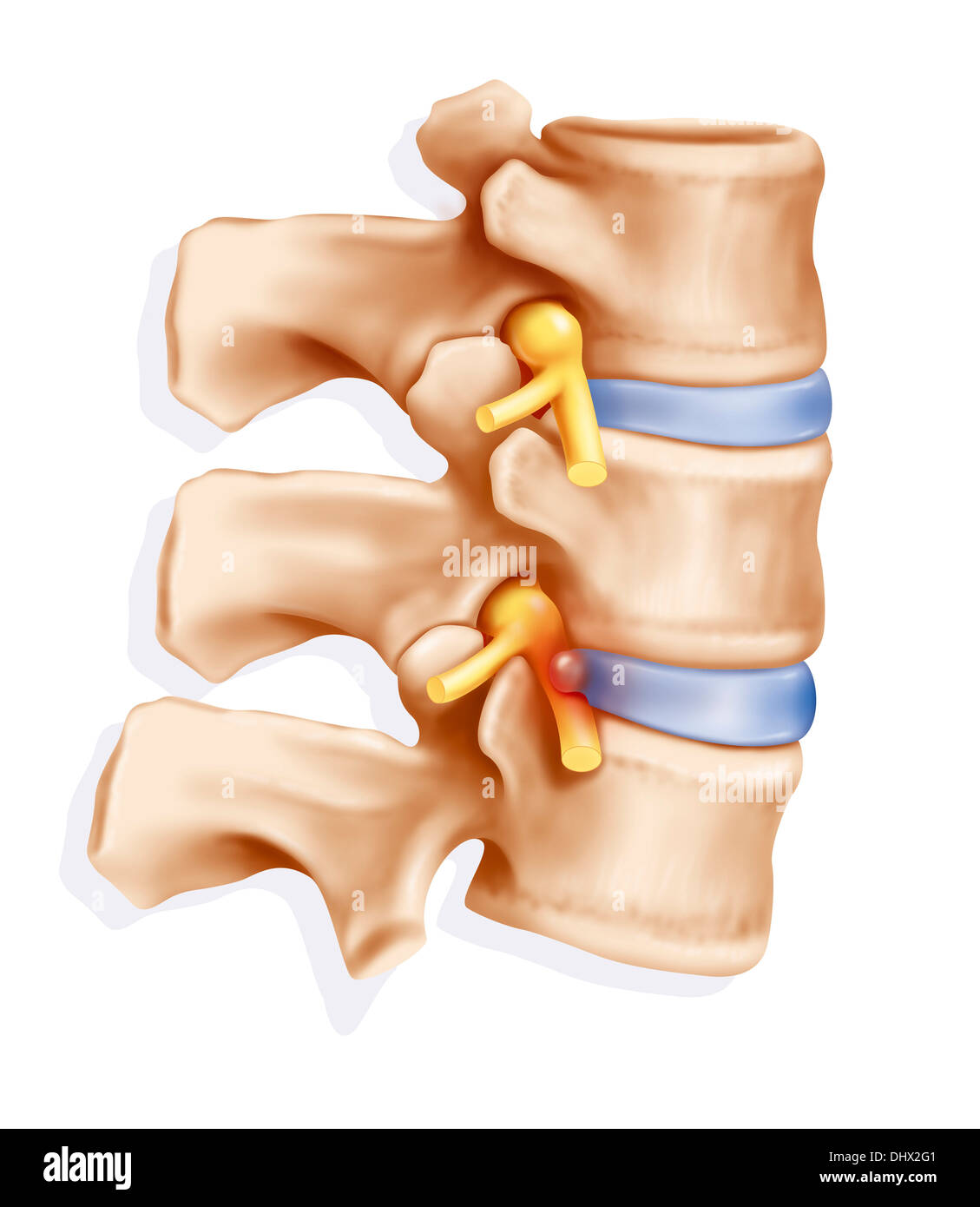 Hernie discale, ILLUSTRATION Banque D'Images