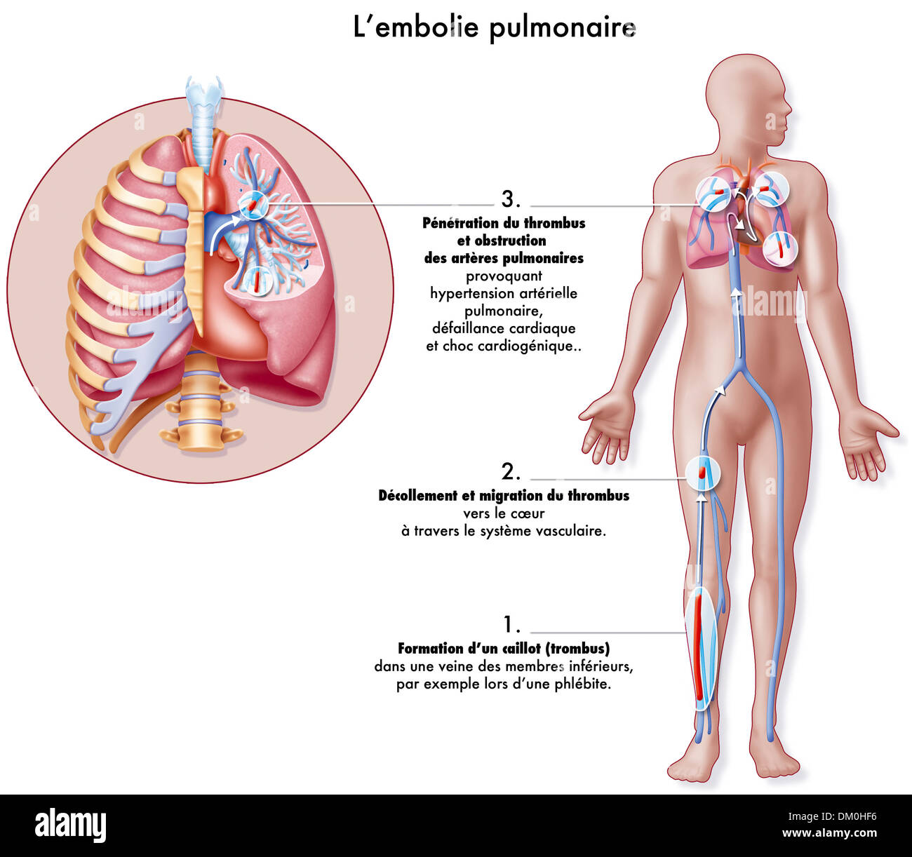L'embolie pulmonaire, dessin Banque D'Images