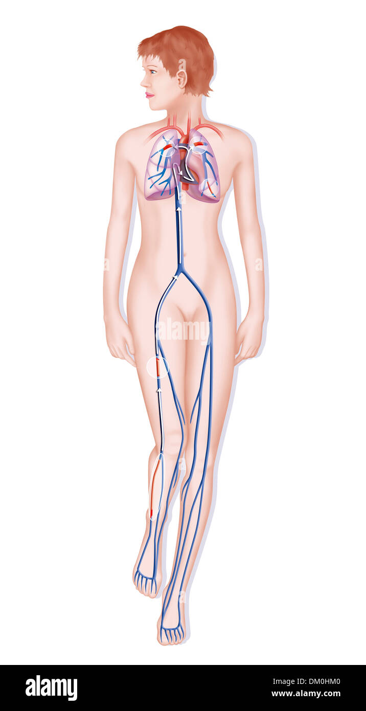L'embolie pulmonaire, dessin Banque D'Images