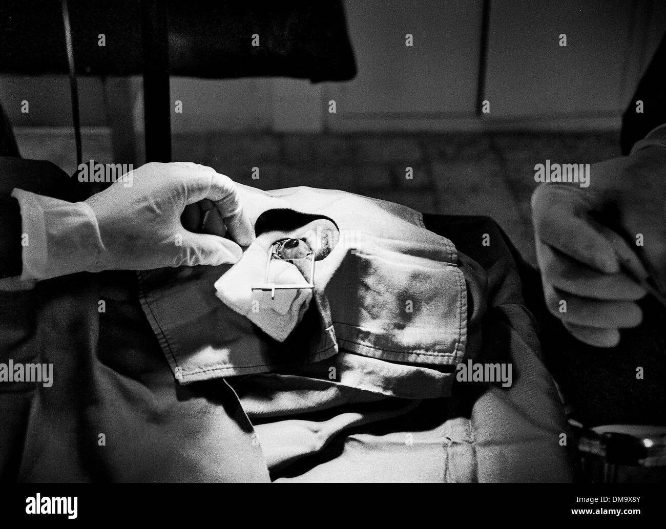 Mar 01, 1993 - Bo, Sierra Leone - Sight Savers charité travaillant sur l'oeil de la femme dans le village de Bo, en Sierra Leone. (Crédit Image : ©/ZUMAPRESS.com) Liasi Theodore Banque D'Images