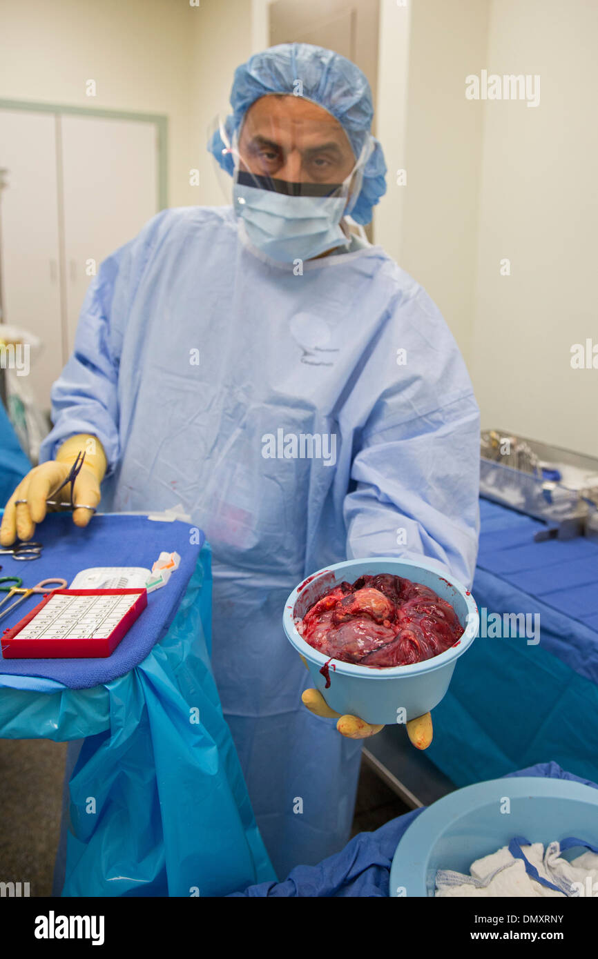 Une masse retiré au cours de l'hystérectomie réalisée sur une femme avec le cancer de l'endomètre Banque D'Images