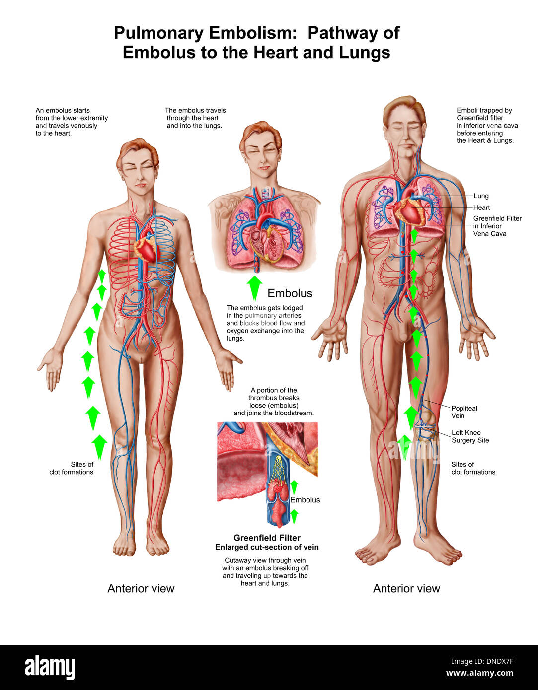 L'embolie pulmonaire, l'embolie de voie pour le cœur et les poumons. Banque D'Images