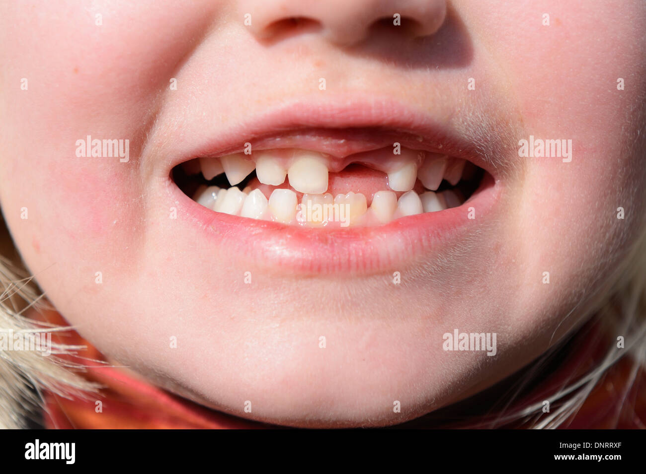 7 ans fille avec son absence d'une dent avant Banque D'Images