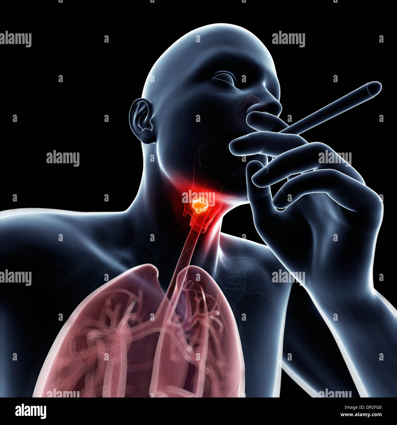 Cancer du larynx, artwork Photo Stock - Alamy