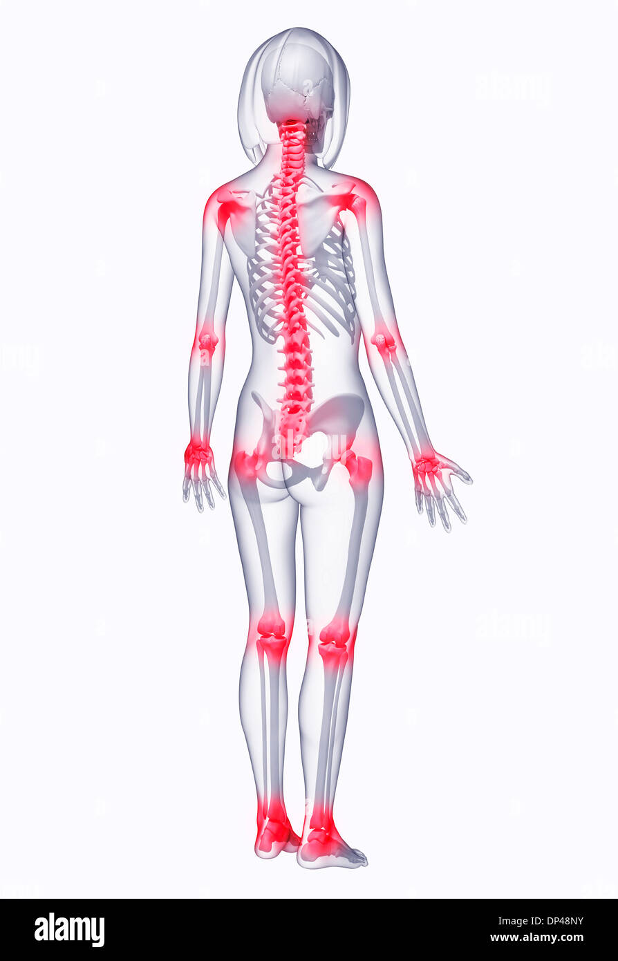 Back pain, artwork Banque D'Images