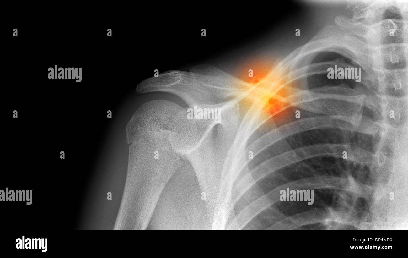Fracture de la clavicule, X-ray Banque D'Images