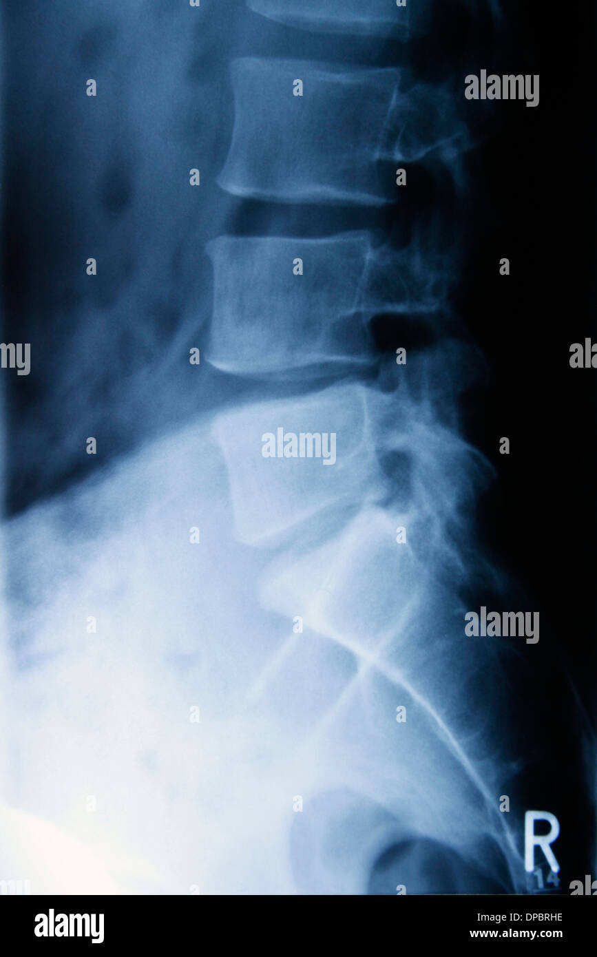 La radiographie du rachis lombaire Banque D'Images