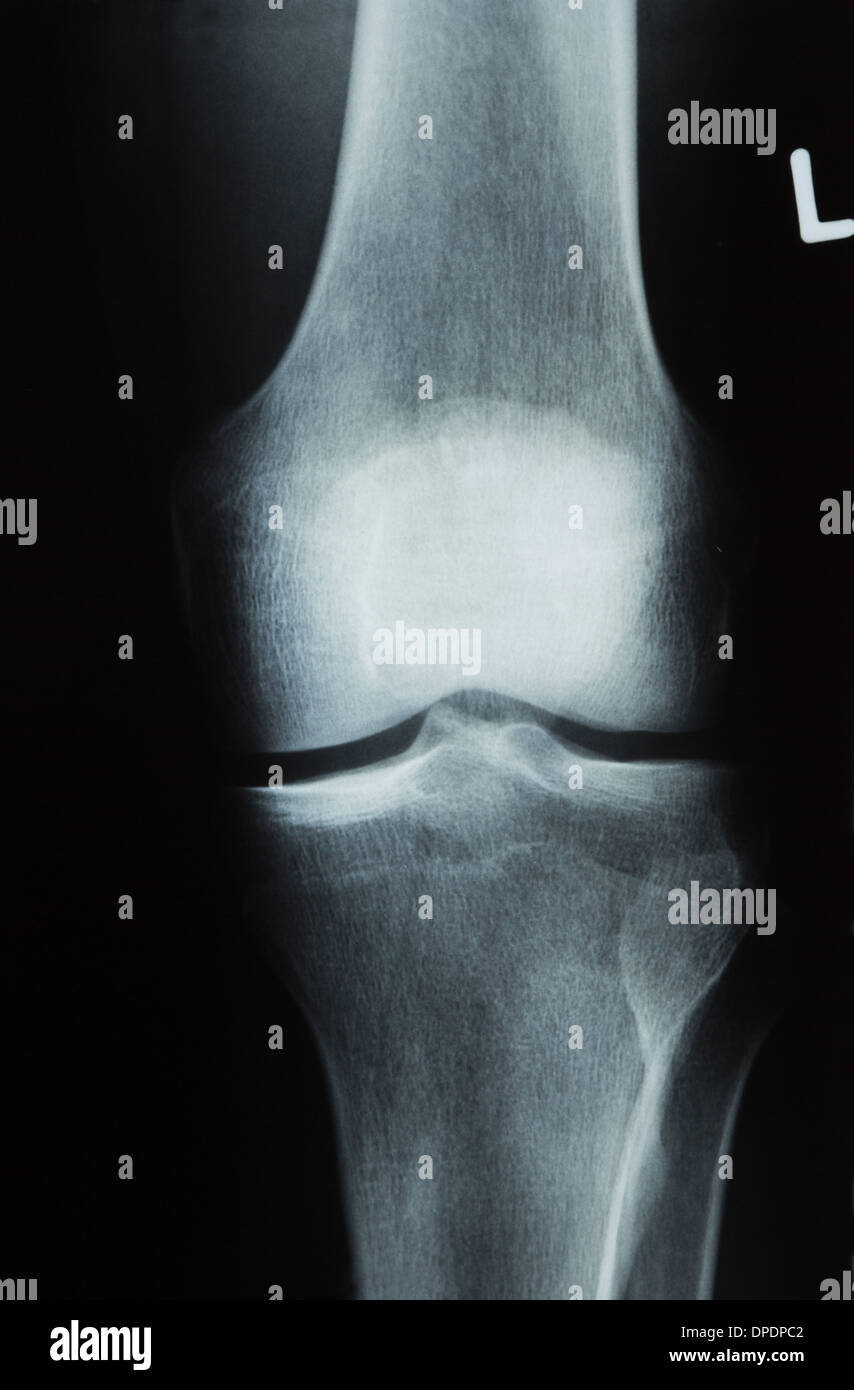 X-ray photographie ou image de Roentgen un genou humain avec le tibia, le fémur, le péroné et la rotule Banque D'Images