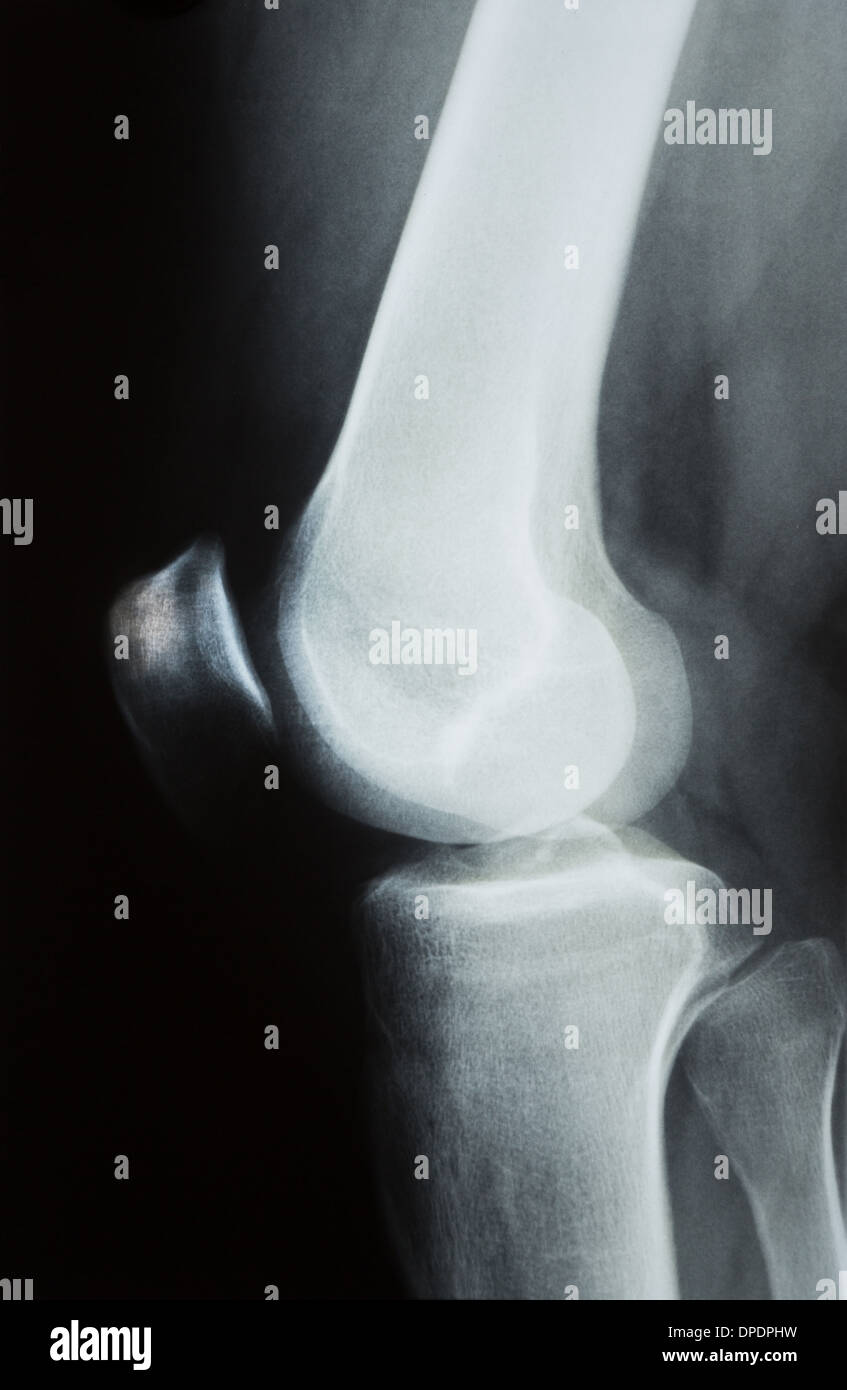 X-ray photographie ou image de Roentgen un genou humain avec le tibia, le fémur, le péroné et la rotule Banque D'Images
