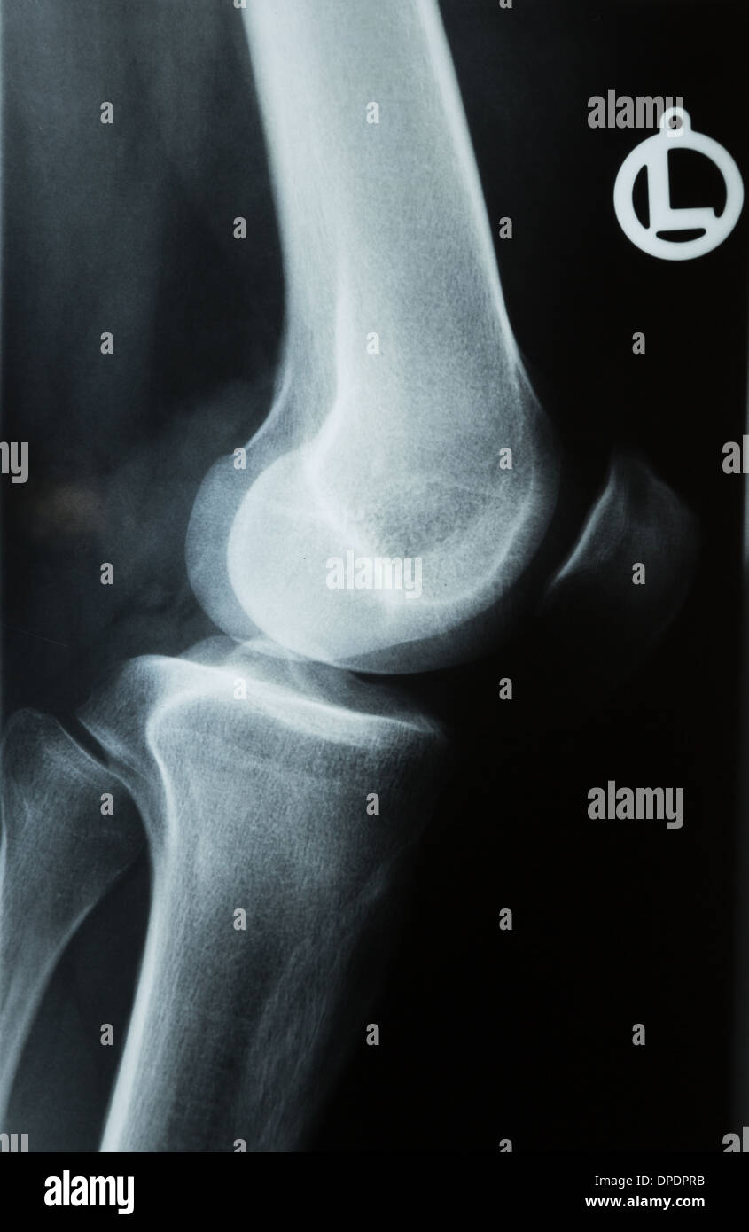 X-ray photographie ou image de Roentgen un genou humain avec le tibia, le fémur, le péroné et la rotule Banque D'Images