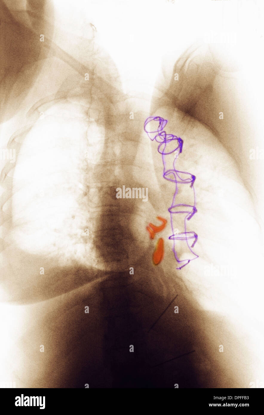 Radiographie montrant les valvules cardiaques artificielles Banque D'Images