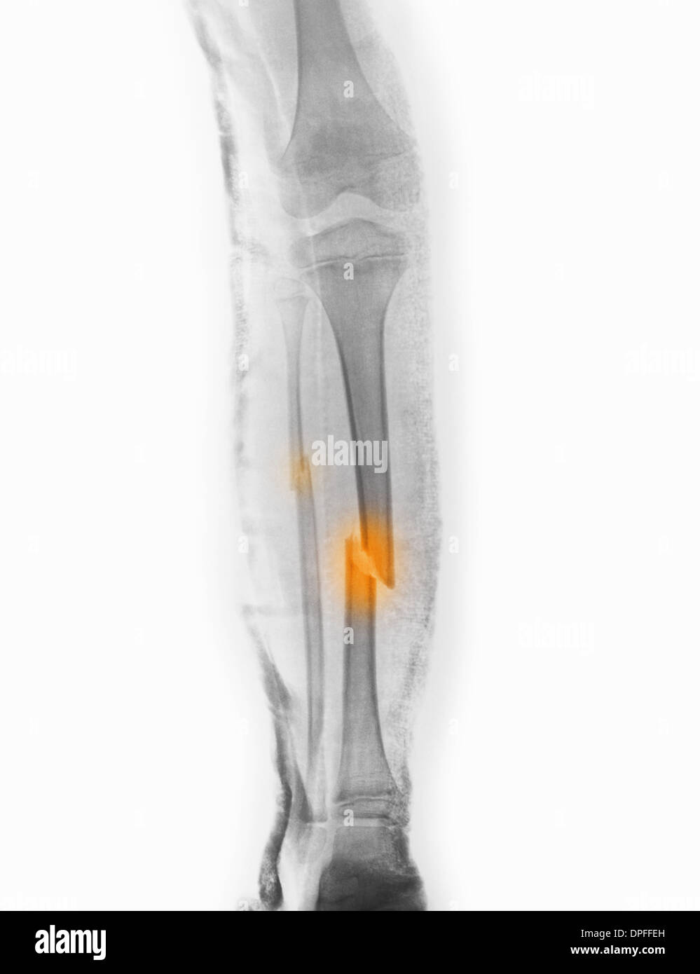 X-ray montrant une fracture du tibia et du péroné Banque D'Images