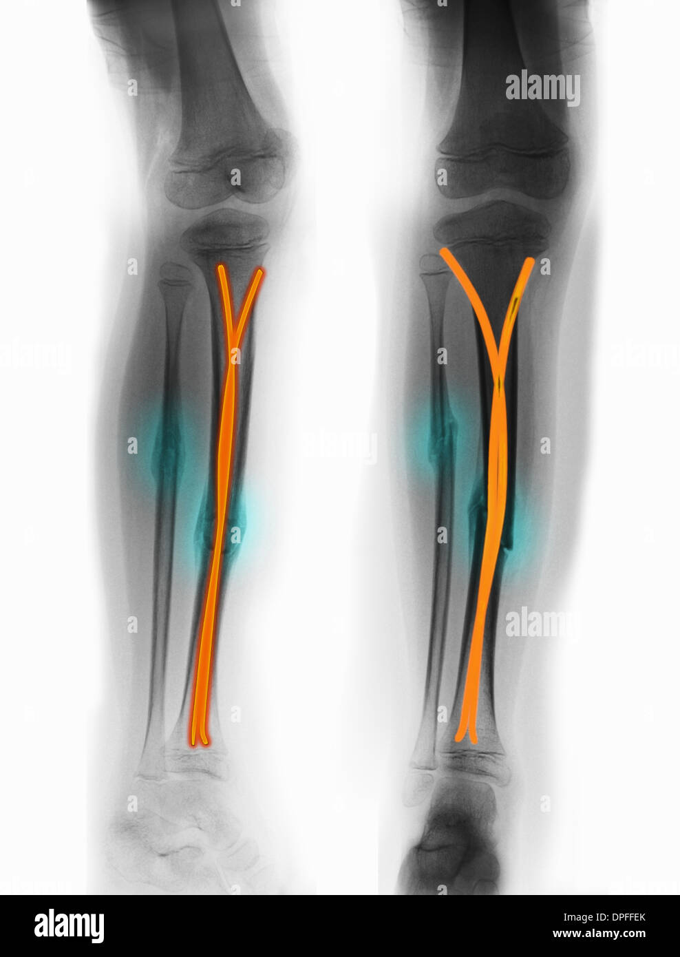 X-ray montrant une fracture du tibia et du péroné Banque D'Images